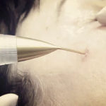 Jett Plasma Lift Medical