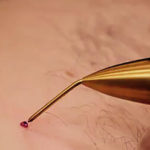 Jett Plasma Lift Medical